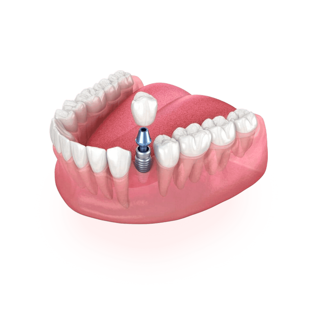 Implante dentário moderno