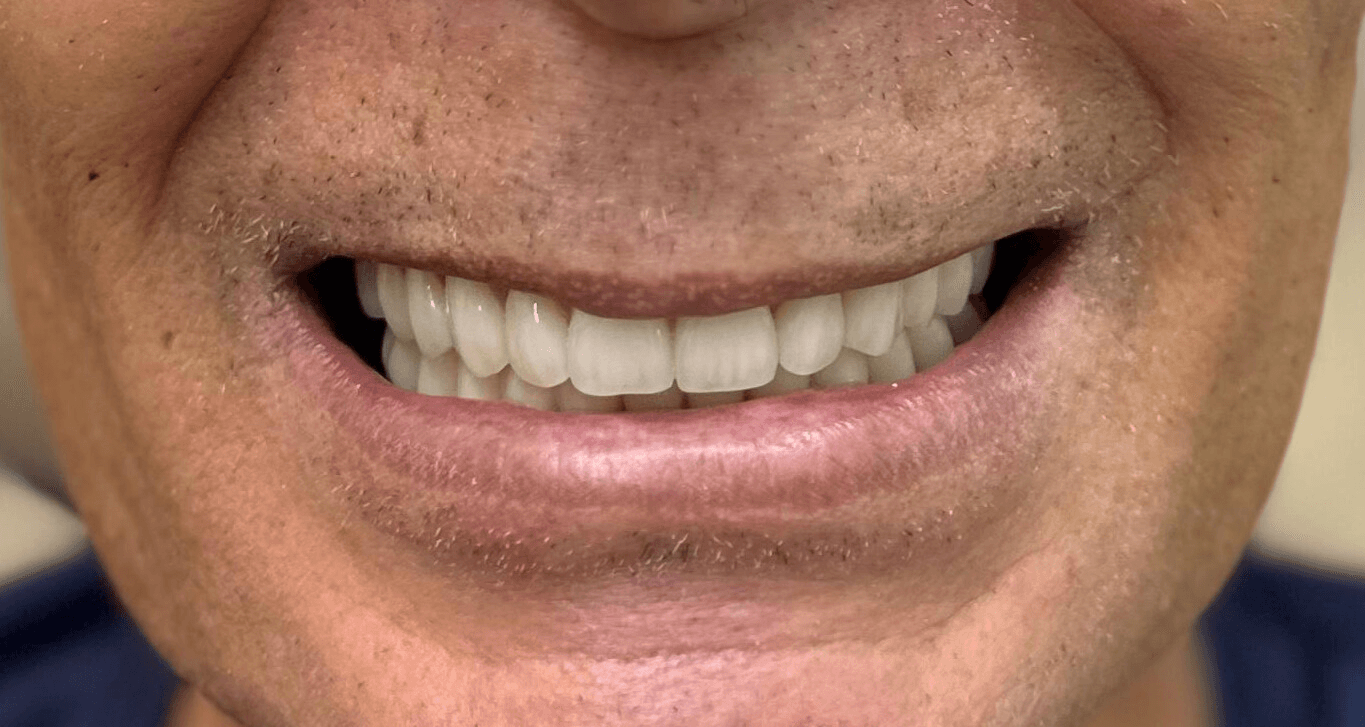 Depois do tratamento